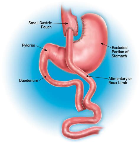 non affordable gastric bypass surgery